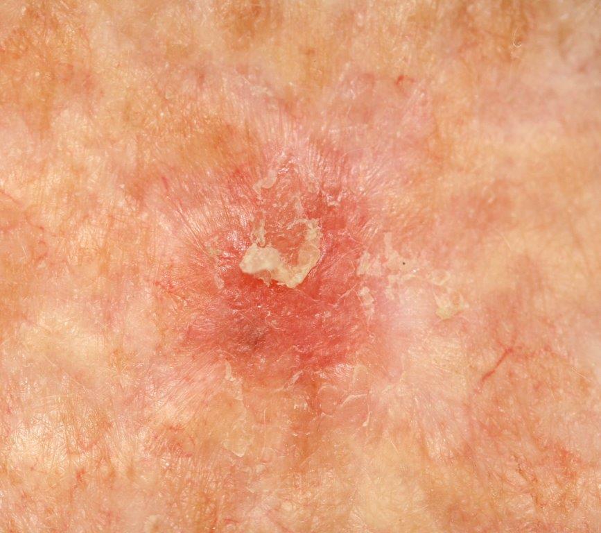 Devon dermatologist Naomi Goldstraw - actinic keratoses 2