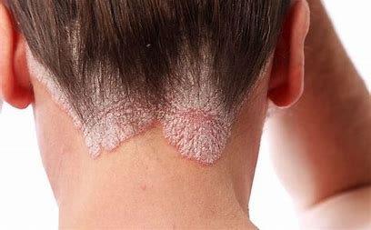 Devon dermatologist Naomi Goldstraw - psoriais scalp