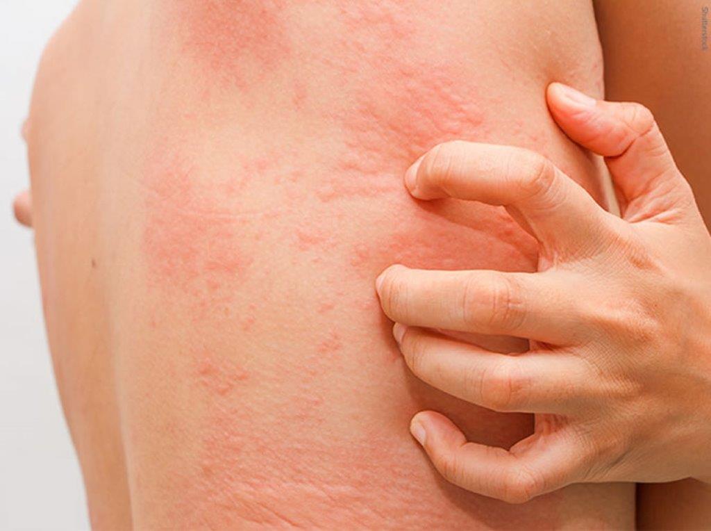 Devon dermatologist Naomi Goldstraw - urticaria 2