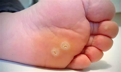 Devon dermatologist Naomi Goldstraw - warts